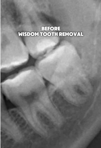 Wisdom Tooth Removal: Essential Dental Care Insights