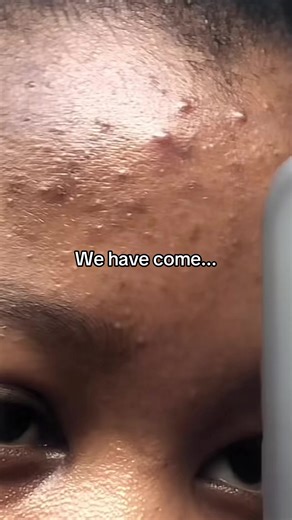 Wow! 🥺🥺🥺 It's possible bantase, I'm not an expert but what helped we was @Garnier_SA @Bioderma South Africa ,Lux soap as well as Tumeric soap I made myself and also bought from @clicksza if you're currently goi through your acne journey, please remember that you are so beautiful and it's a matter of finding the right products for your skin, not what influencers and creators are selling. Sometimes it works and sometimes it worsens so be careful! #fyp #tiktoksouthafrica #contentcreator #skinjou