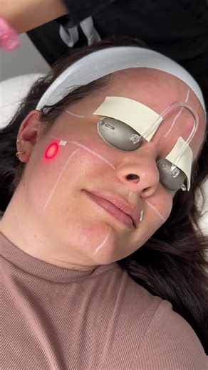 Our Instant Glow Laser Facial's name says it all: immediate results in less than 30 minutes...the perfect pick-me-up for a brighter, tighter, more even complexion. #instantglow #laserfacial #laseraway