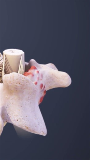 Spinal decompression surgery treats spinal cord compression