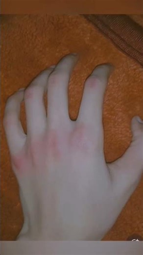 Pov my hands #asthmaticaone