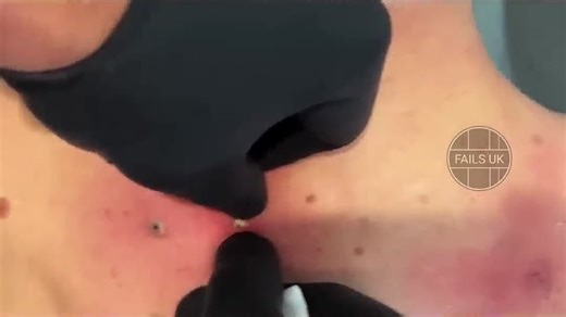 GIANT BLACLHEADS ON BACK #PIMPLE #blackhead #pimplepoppersatisfying