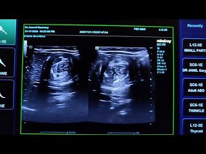 Intussusception Ultrasound