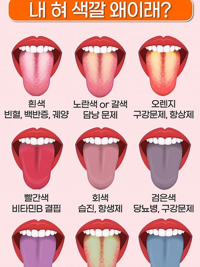 혀 색깔로 알아보는 건강 상태
