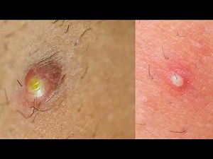 Bolitas o granos en la vagina 10 causas y qué hacer con imágenes
