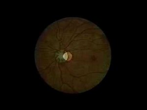 Opthalmoscopic Examination