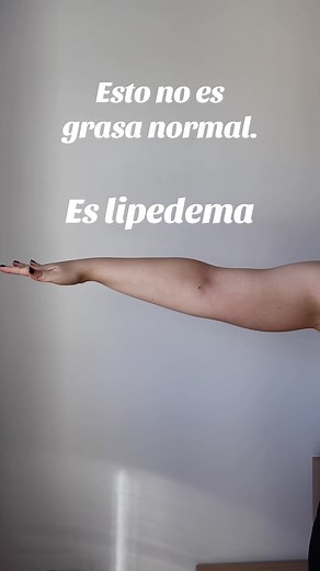 Conoce el Lipedema: Más que Grasa Normal