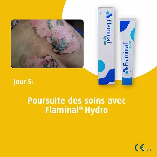 Étude de cas - traitement d'une brûlure au 2ème degré avec Flaminal®