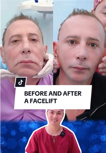 BEFORE AND AFTER A FACELIFT #facelift #facelifting #trend #tren #australia