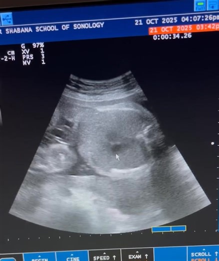 58K views · 939 reactions | Fetal anomaly scan | Dr. Shabana's School of Sonology. | Facebook