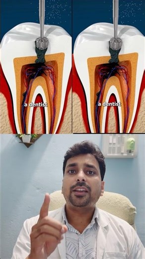 दांत का RCT कैसे किया जाता है? 🦷 Root Canal Treatment Step by Step #reels #youtubeshorts #doctor