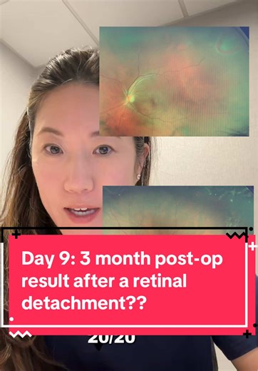 20/20 Vision Recovery After Macula-On Retinal Detachment