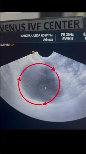 Hydrosalpinx & IVF Success | Why Laparoscopic Salpingectomy Is Important Before Embryo Transfer