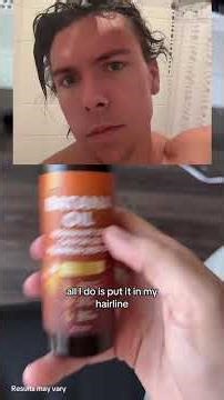 Stopped micro needling for my receding hairline after discovering Batana oil