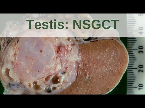 Testicular germ cell tumours - Non seminomatous germ cell tumours - Pathology mini tutorial