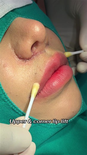 ครบกำหนดตัดไหม ❤️ คุณหมอเปิ้ล นายแพทย์พลศักดิ์ วรไกร เลขที่ใบ ว.33206 แพทย์ทั่วไป ปริญญาตรีแพทยศาสตร์บัณฑิต ***เป็นตัวอย่าง ผลการรักษาพยาบาล สำหรับผู้ป่วยเฉพาะราย*** #เ#เก็บบันทึกภาพเป็นปัจจุบันป#ปากกระจับต#ตัดปีกจมูกมอเปิ้ล