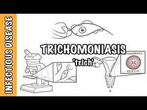 Trichomoniasis - Causes, Symptoms, Diagnosis & Treatment • Video • MEDtube.net