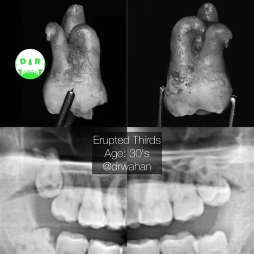 Upper Wizzies #drwahan #wisdomteeth #upperwisdomteeth #surgeryvideo #stepbystepwisdomteeth #howtoextractteeth #odonto #odontologia #oralsurgeon