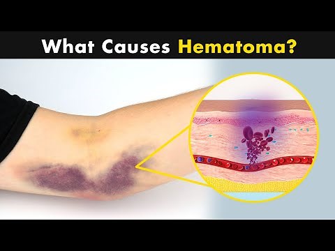 Hematoma - Why it happens? | Symptoms, Causes and Treatment (Urdu/Hindi)