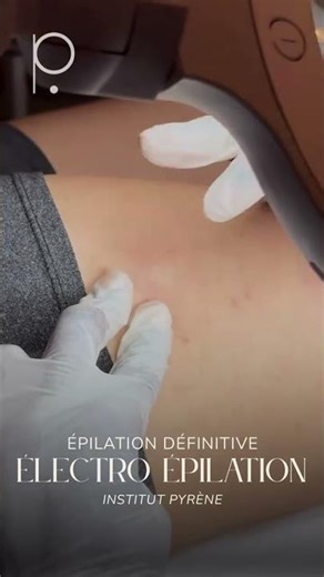 Pyrène - Expert #epilationdefinitive #electroepilation