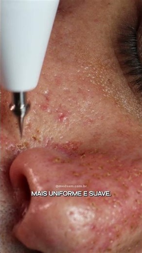 Equipamento portátil de jato de plasma | Plasmax da KLD