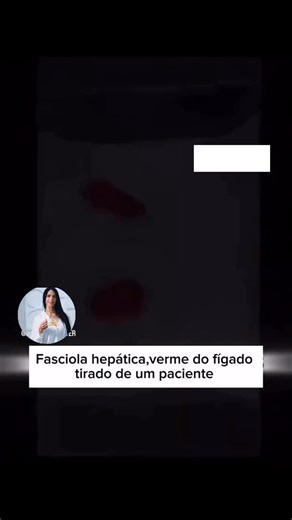 Janaína Sousa on Instagram: "🪱A infecção por Fasciola hepatica, conhecida como fascíola hepática ou “verme do fígado”, ocorre quando o hospedeiro ingere água ou vegetais contaminados com a forma infectante (metacercárias). 🪱O parasita passa por diversas fases: os ovos são eliminados nas fezes, liberam larvas que infectam caramujos de água doce e, posteriormente, as cercárias se transformam em metacercárias nos vegetais aquáticos. Após a ingestão, as larvas migram para o fígado, causando lesões