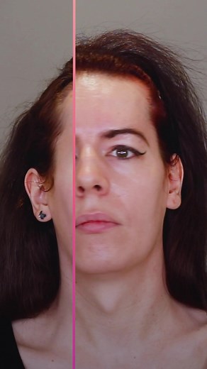 Amber's Immediate Post-Op Results After 8 Days | Facial Feminization Surgery