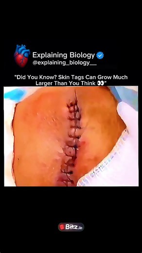 Explaining Biology on Instagram: "😳 Did You Know? Skin Tags Can Grow MUCH Larger Than You Think! 🇺🇸🧬 It looks shocking… but there’s real medical science behind this 👇 🧬 What’s happening here? • Skin tags (acrochordons) are benign skin growths made of skin, collagen & blood vessels • They develop due to friction, pressure & hormonal changes • Common areas: neck, armpits, groin & waistline 📈 Why do some grow so large? • Poor blood drainage allows slow enlargement over time • Obesity, diabet