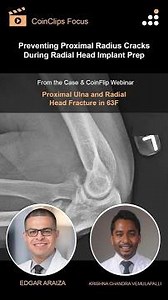 Preventing Proximal Radius Cracks During Radial Head Implant Prep