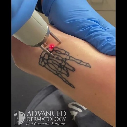 Tattoo removal at Advanced Dermatology and Cosmetic Surgery
