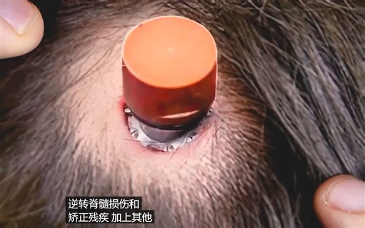 马斯克的脑机接口(BCI)开始人体试验！