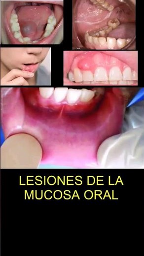 Lesiones de mucosa oral Parte 1 #odontologia #dentista #shorts