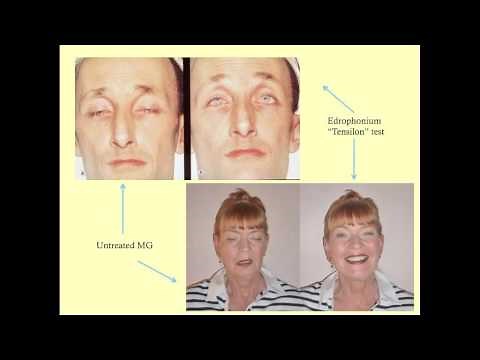 Myasthenia Gravis and LEMS - CRASH! Medical Review Series