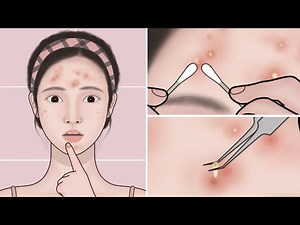 ASMR Acne Treatment At Home | Pimple, Acne Removal Animation | Meng's Stop Motion
