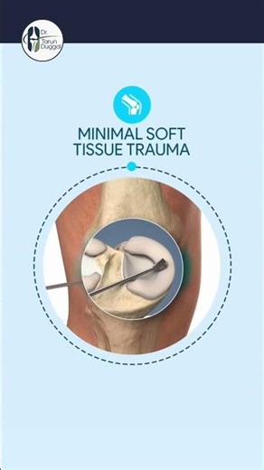 Benefits of Arthroscopy vs. Traditional Open Surgery | Orthopedic Insights