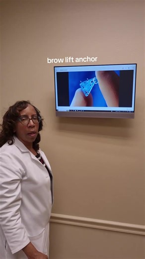 Understanding Endotine Brow Lift Anchors in Plastic Surgery