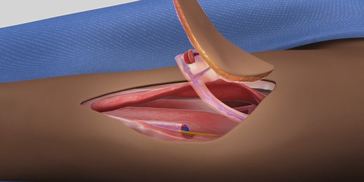 Anterolateral Thigh Perforator Flap Harvest - TVASurg - The Toronto Video Atlas of Surgery