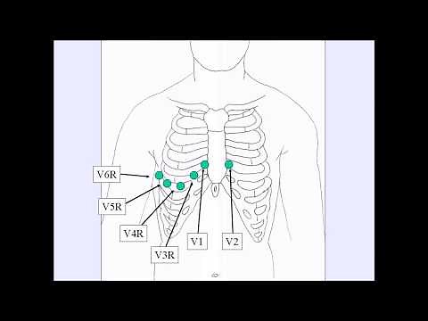 How To: Complete Right Side ECG