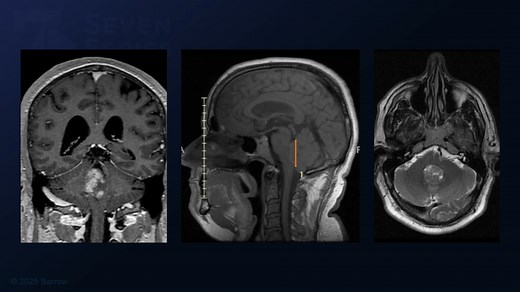 #480: Suboccipital Craniotomy and Telovelar Approach for Fourth Ventricular Ependymoma Resection - All Videos - Seven Series Collection