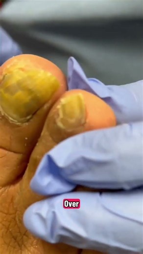 The Biggest Trophy Nail Why Your Big Toenail Gets Thick and How Long It Takes to Grow Back