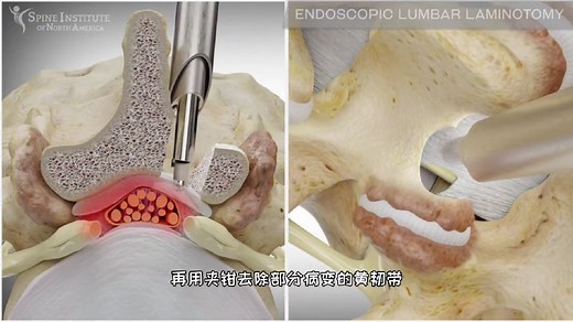 腰椎椎管狭窄的手术治疗过程，3D演示。。#科普新知自习室