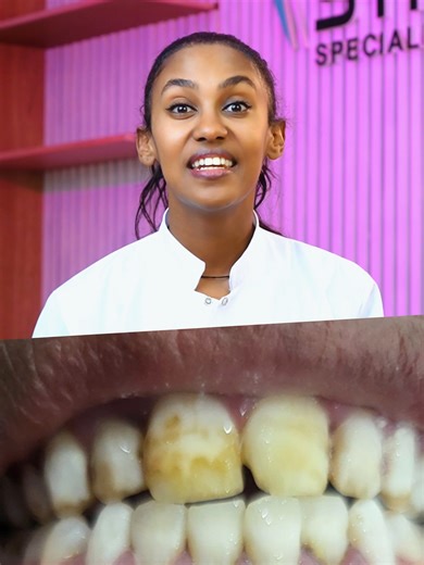 Two dental issues. One seamless solution. See how direct composite bonding transformed our patient’s smile! #directcompositebonding #dentalclinic #ethiopian #addisababa #dentalclinicnearme