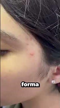 🌿✨ Do you have acne erythema (those red spots that remain after pimples)? 😣