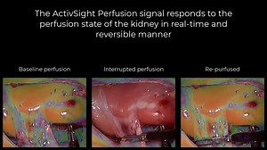 ActivSight-Renal Hilum Occlusion - ActivPerfusion A/R Visual Overlay real-time & reversible response to kidney perfusion