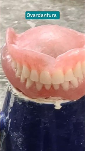 overdenture