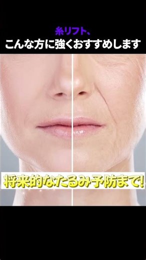 糸リフト、こんな方に強くおすすめします！！#フェイスライン #ほうれい線 #たるみ #リフティング #糸リフト