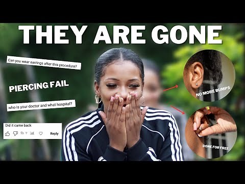 HOW I GOT RID OF MY KELOIDS(Piercing bumps, Ear Scar, What are they, before + after storytime