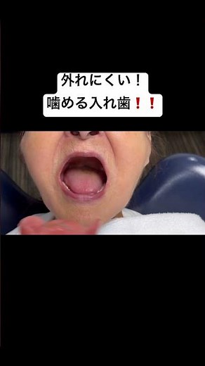 外れにくい噛める入れ歯！ #総入れ歯 #部分入れ歯#義歯