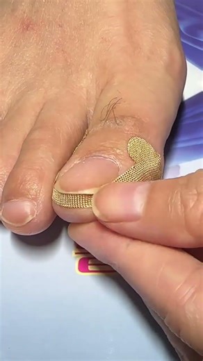 Toe Nail Fixer| Ingrown Toenail Cleaning & Care #ToenailFix #NailCare #FootCare #PedicureClean