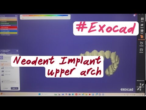 Neodent Implant System Full Arch Bridge Design in Exocad | Precise Scan Body Matching #exocad